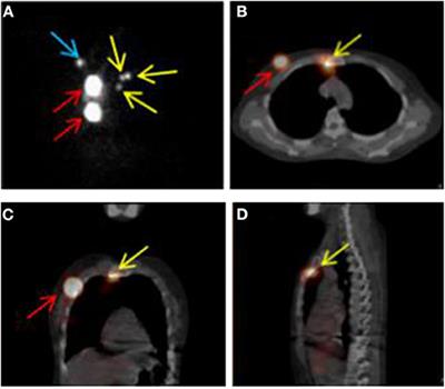 Definition of Internal Mammary Node Target Volume Based on the Position of the Internal Mammary Sentinel Lymph Nodes Presented on SPECT/CT Fusion Images